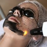 Microlaser Peel Treatment in Lahore , Pakistan