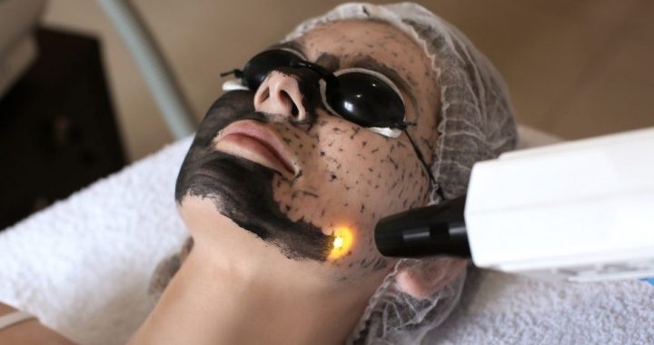 Microlaser Peel