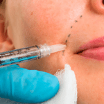 What Is Included in Dermal Fillers to Improve Skin?