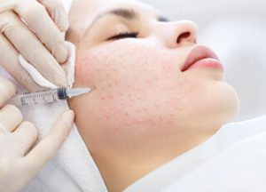 Mesotherapy Treatment in Lahore - Mesotherapy Treatment in Pakistan