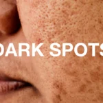how to remove dark spots