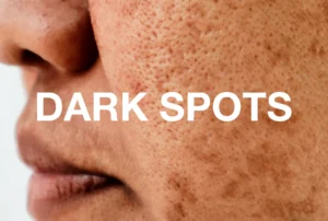 how to remove dark spots