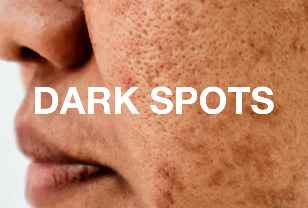 how to remove dark spots