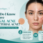 How Do I Know If I Have Fungal Acne or Bacterial Acne? Comparison of fungal acne and bacterial acne symptoms on facial skin with expert skincare guidance from Cosmetique Clinic.