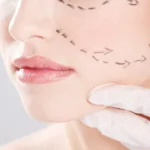 Face lift surgery for youthful facial skin glow