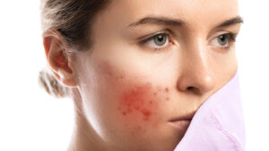 Tired of Dark Spots? Here's How a Skin Specialist Can Help