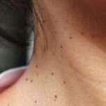 Skin tags appearing on a woman’s neck area