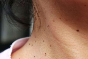 Skin tags appearing on a woman’s neck area