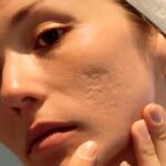 Acne scar and mole removal treatment for clearer and healthier-looking skin