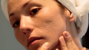 Acne scar and mole removal treatment for clearer and healthier-looking skin