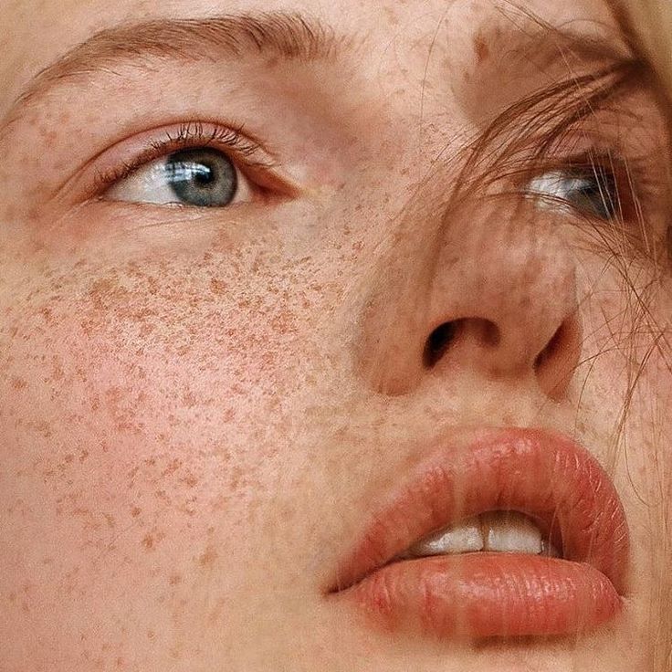 Skin specialist examining freckles on a patient’s face