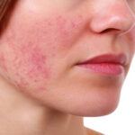 Early signs of lupus with skin rash and joint pain