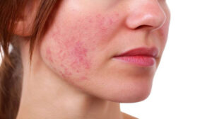 Early signs of lupus with skin rash and joint pain