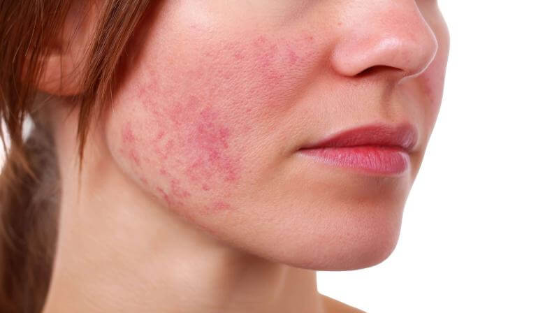 Early signs of lupus with skin rash and joint pain