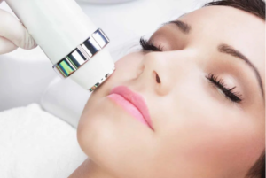Microlaser Peel treatment for smoother skin texture and advanced laser skin resurfacing