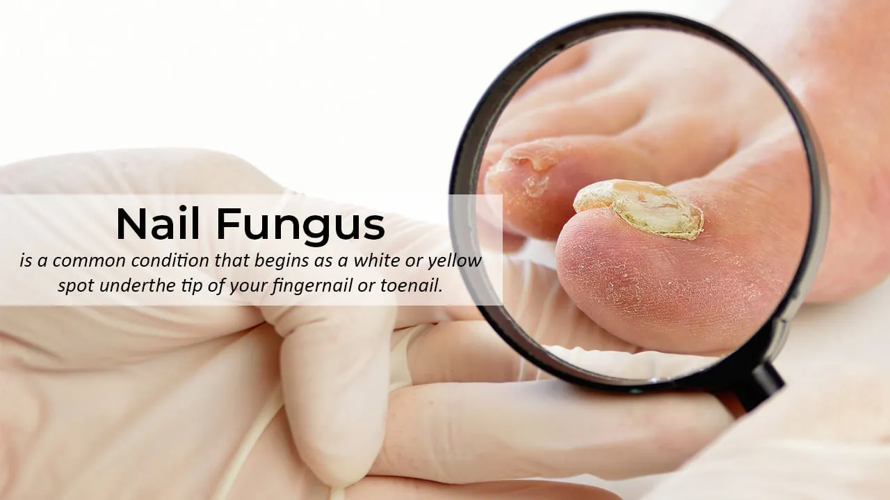 Nair Fungus Treatment