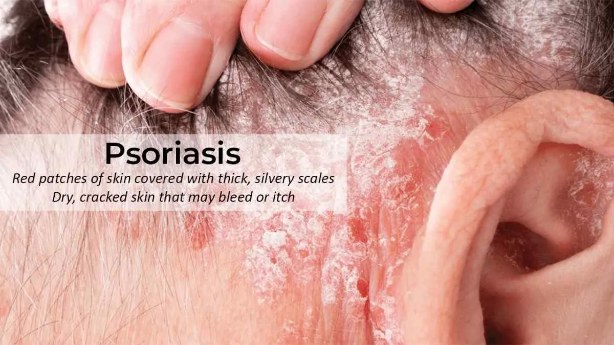 Psoriasis Treatment