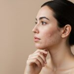 Skin specialist examining a patient with acne and recommending professional treatment