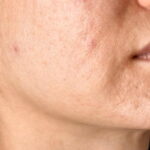 Skin specialist providing advice for acne scars and atrophic scars treatment, showing skin texture improvement and professional dermatology care.