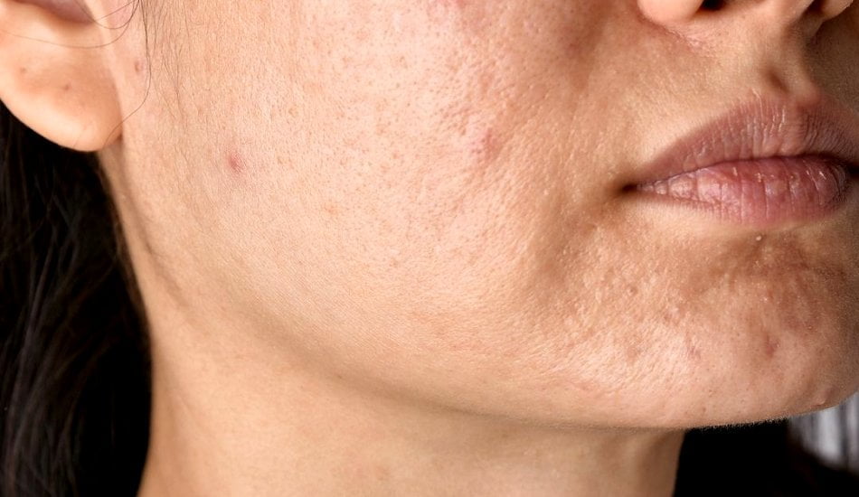 Skin specialist providing advice for acne scars and atrophic scars treatment, showing skin texture improvement and professional dermatology care.