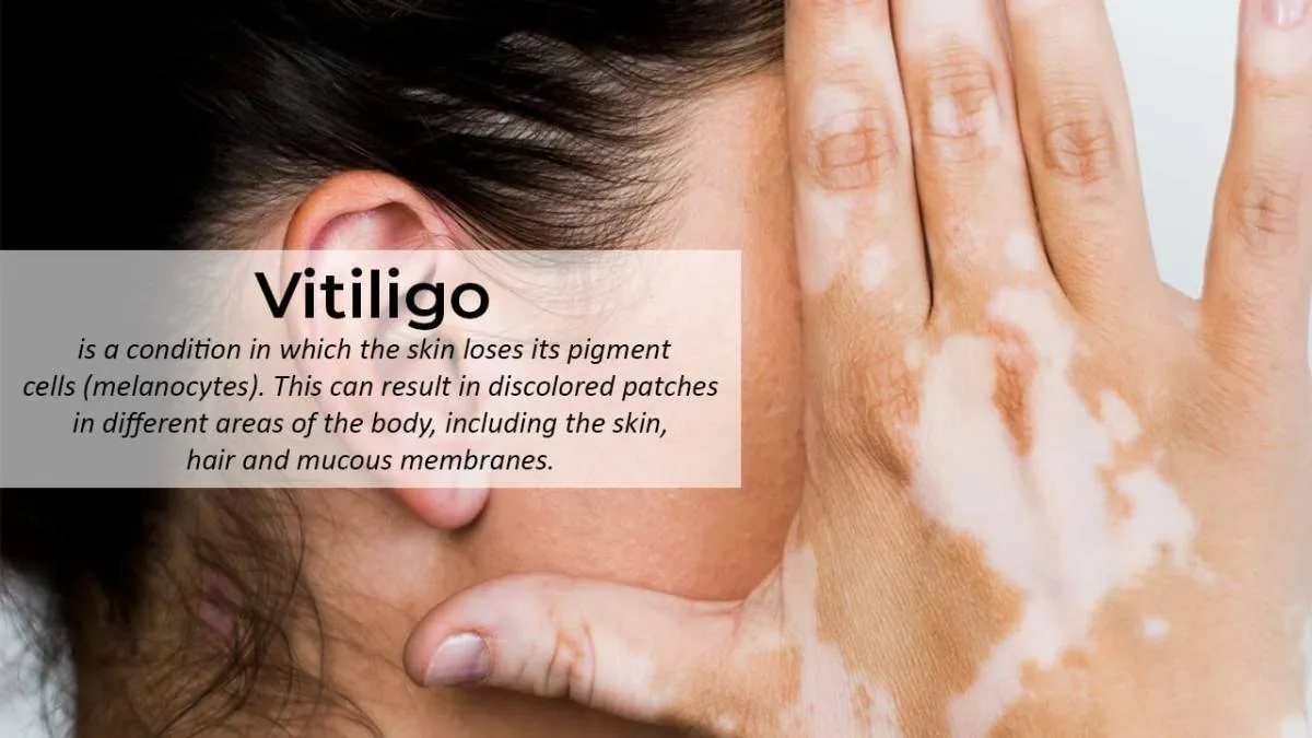 Vitiligo Treatment