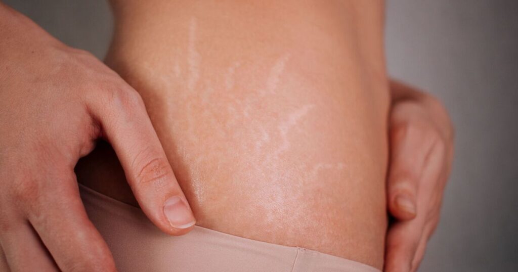 Stretch marks appearing on different body areas due to skin stretching