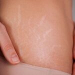 Stretch marks appearing on different body areas due to skin stretching