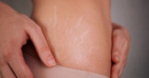 Stretch marks appearing on different body areas due to skin stretching