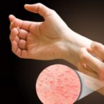 Latex allergy symptoms causing skin irritation and allergic reactions