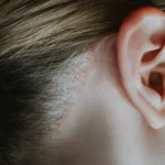 Seborrheic Dermatitis affecting scalp and skin with flaky patches