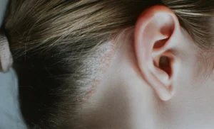 Seborrheic Dermatitis affecting scalp and skin with flaky patches