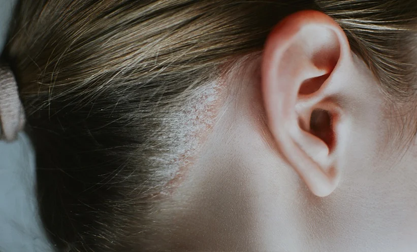 Seborrheic Dermatitis affecting scalp and skin with flaky patches