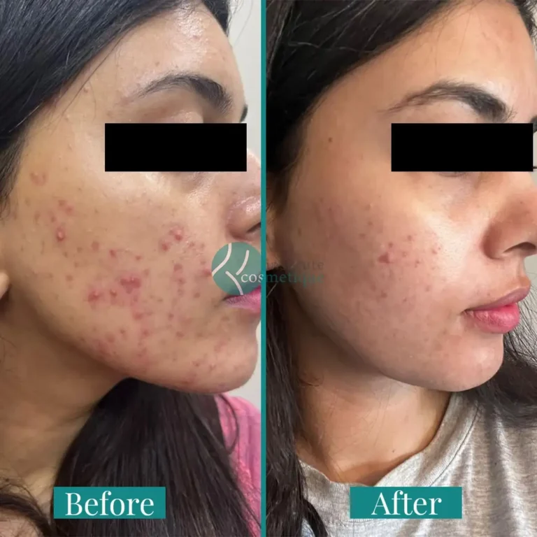 acne-scar-removal-treatment-before-after