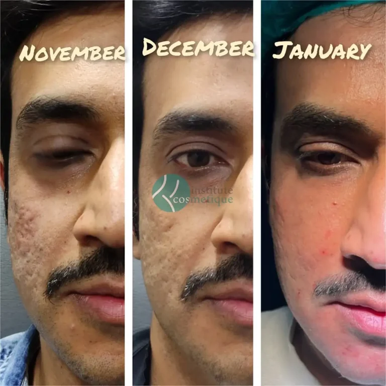 acne-scar-treatment-before after