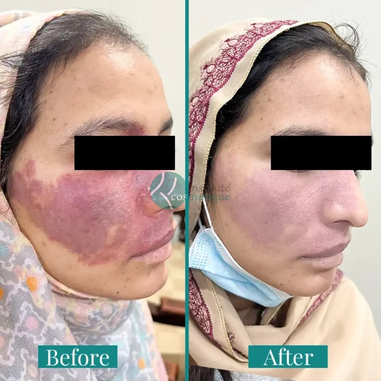 birthmark-treatment-clinic