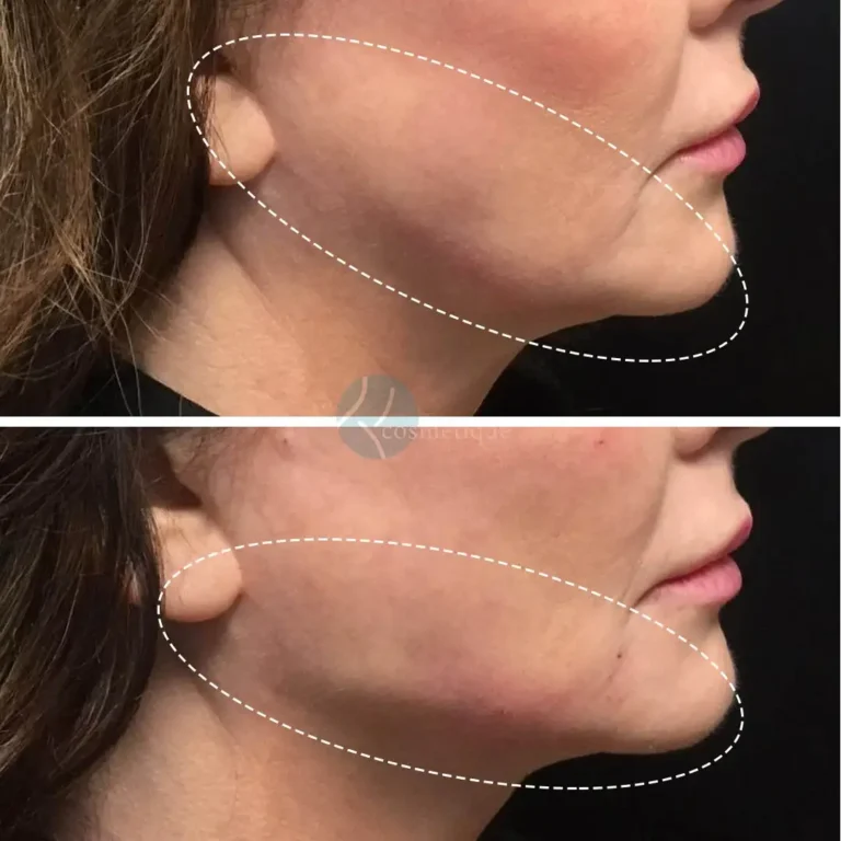 defined-jawline-results
