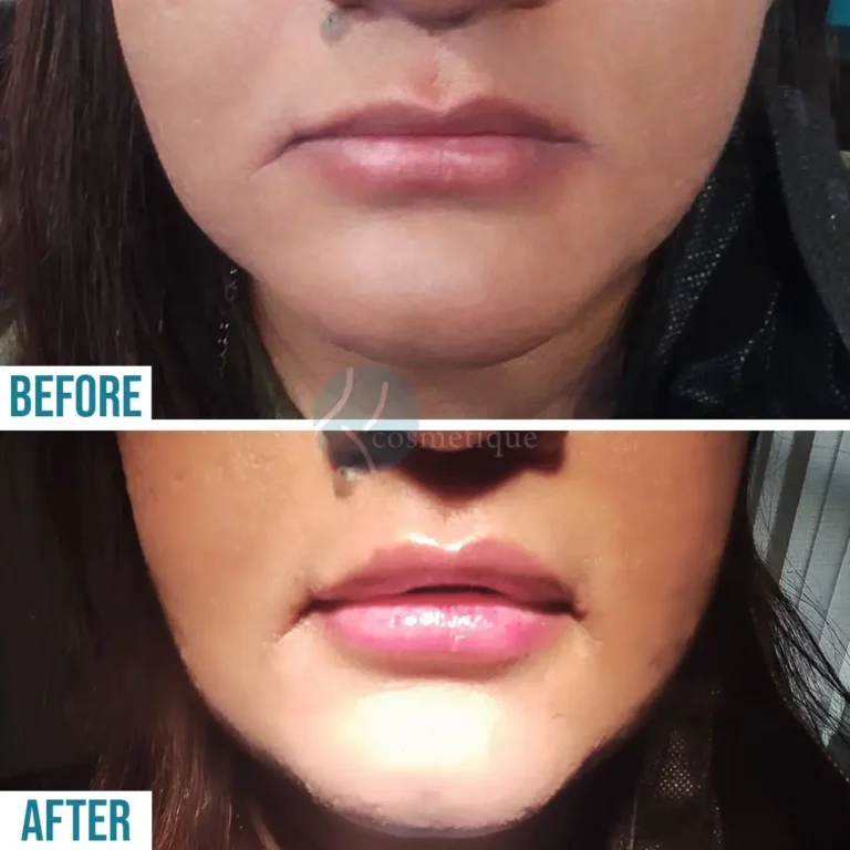 lip-enhancement-before-after