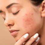 Natural skincare routine for reducing the appearance of acne scars