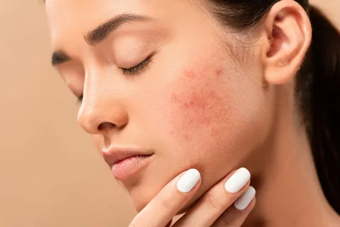 Natural skincare routine for reducing the appearance of acne scars