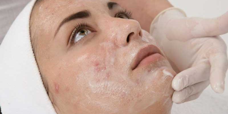 Acne-Chemical-Peel Best Chemical Peel Treatment in Lahore