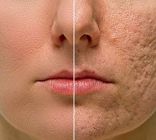 best acne scars removal treatment in lahore, best skin specialist in pakistan, laser treatment in lahore