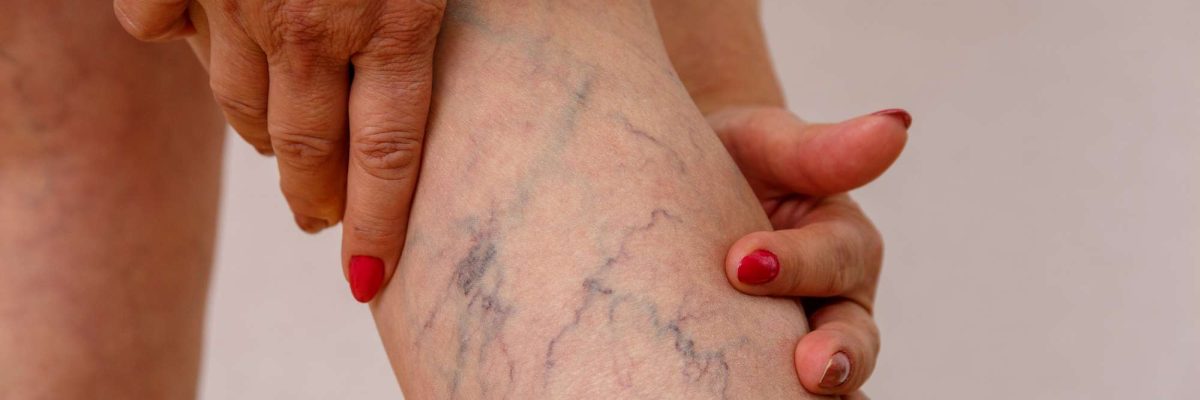 Elderly,Woman,In,White,Panties,Shows,Cellulite,And,Varicose,Veins leg vein Treatment in Lahore, best laser treatment in lahore, Pakistan