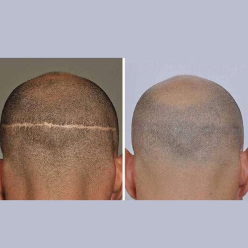 Fut Hair Transplant in Lahore FUT hair transplant in Lahore, best hair transplant in Pakistan, Best hair transplant Surgeon in Lahore