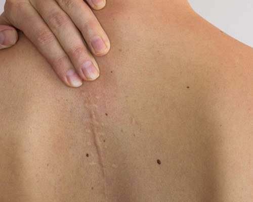 Hypertrophic Scars treatment in lahore, best skin specialist in lahore, laser treatment in lahore