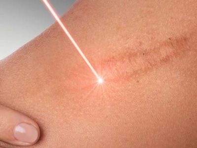Scar Prevention treatment in lahore, best skin treatment in lahore, laser treatment in lahore