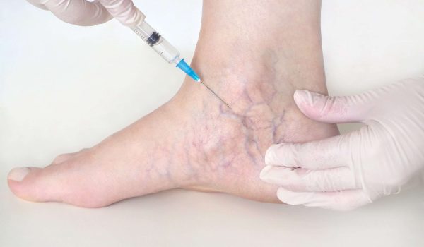 Sclerotherapy aser treatment for varicose veins in Lahore, aser treatment for leg veins, best skin specialist, best dermatologist in pakistan, leg veins injection treatmnet