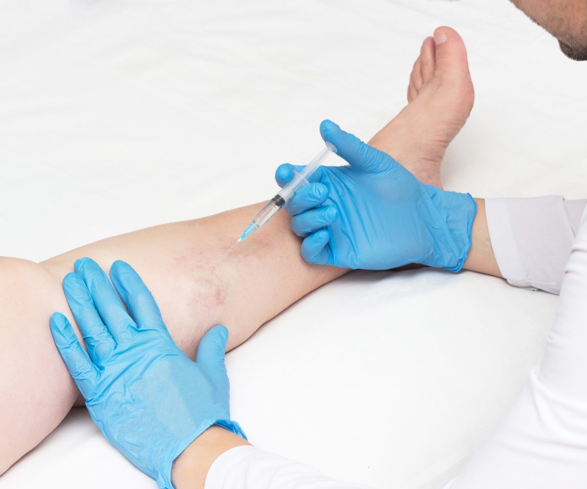 Doctor performs sclerotherapy for varicose veins on the legs, varicose vein treatment, copy space, injection best skin specialist in lahore