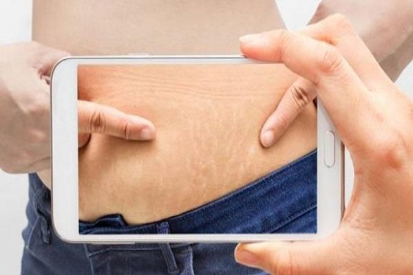 Strach marks removal treatment in Lahore Strach marks removal treatment in Lahore, skin damage treatment in Lahore
