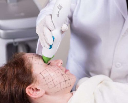 THERMAGE® treatment in Lahore, skin tightening treatment in pakistan, pulsed dye laser treatment in Lahore