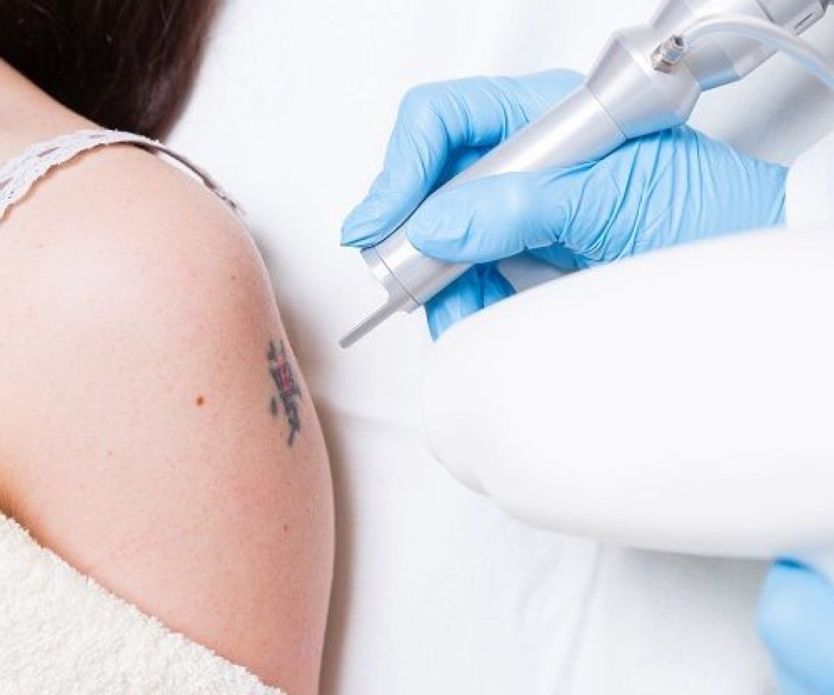 best laser removal treatment in lahore best skin specialist in lahore